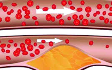 دراسة استرالية : الكوليسترول الضار ينقل خلايا السرطان