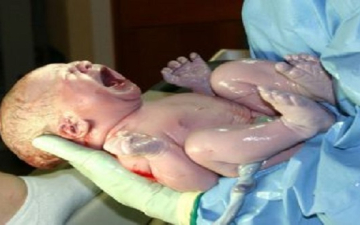 ولادة طفل بعد زراعة مبيض .. عملية ناجحة من المرة الأولى