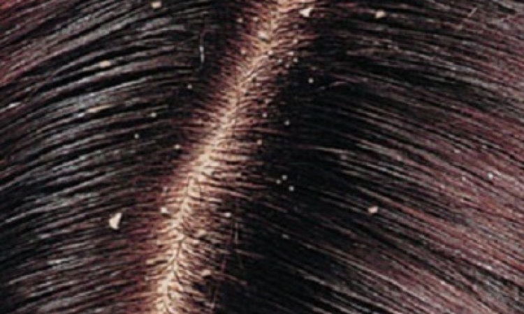نصائح للتخلص من قشرة الشعر المزعجة