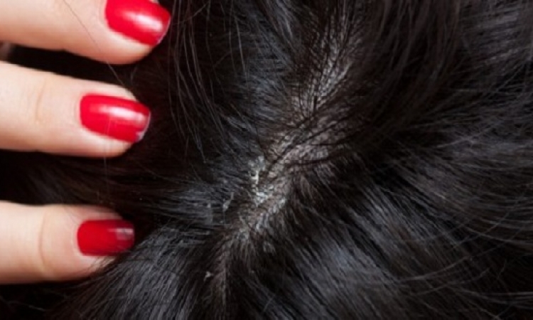 6 طرق تخلصك من قشرة شعرك نهائيا