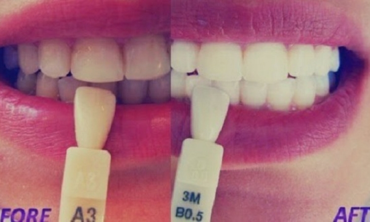 وصفة مجربة وفعالة لتبيض الأسنان دون الذهاب للطبيب !!